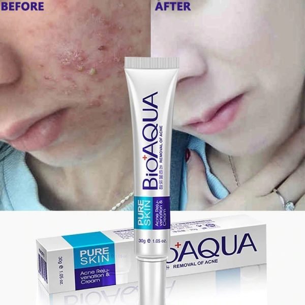 Unisex Original Bio-aqua Acne Cream For All Skin